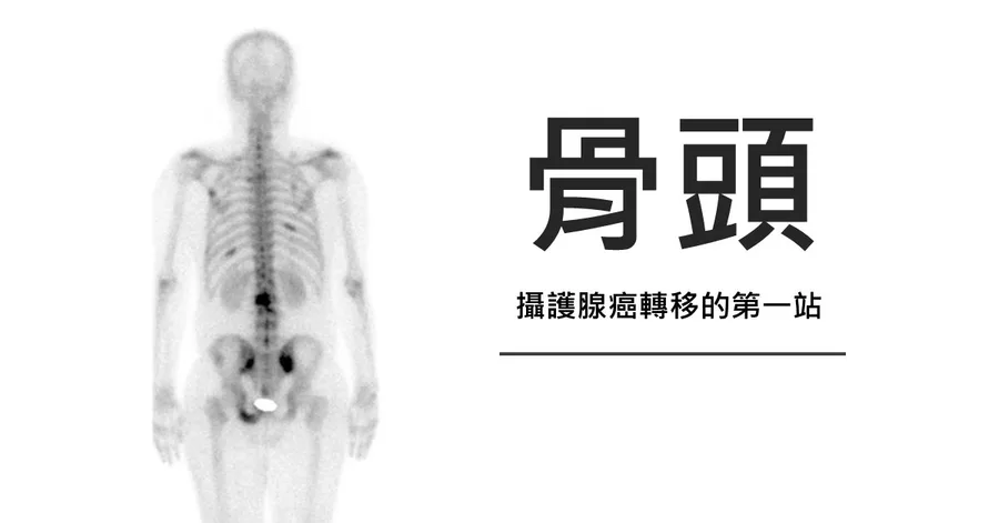文章主視覺。一張全身骨骼掃描影像，脊椎與骨盆有數處深色訊號，右側標題為「骨頭」，副標為「攝護腺癌轉移的第一站」。